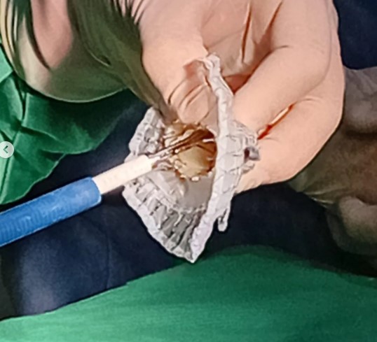 Inédito en la región y la tercera en el país: novedosa y revolucionaria intervención cardiaca mínimamente invasiva realizada en sanatorio posadeño 9 Inédito en la región y la tercera en el país: novedosa y revolucionaria intervención cardiaca mínimamente invasiva realizada en sanatorio posadeño imagen-8