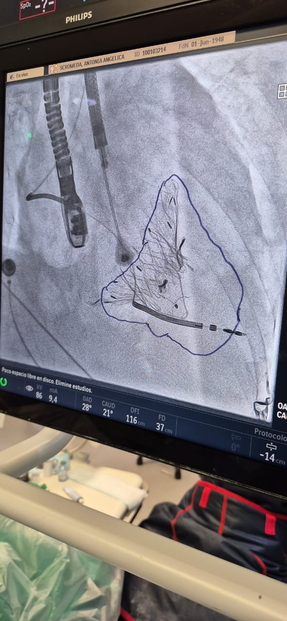 Inédito en la región y el tercero en el país: novedosa y revolucionaria intervención cardiaca mínimamente invasiva realizada en sanatorio posadeño 5 Inédito en la región y el tercero en el país: novedosa y revolucionaria intervención cardiaca mínimamente invasiva realizada en sanatorio posadeño imagen-4