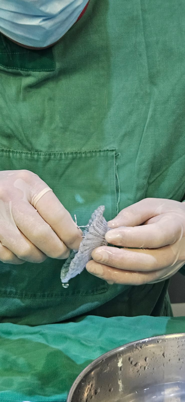 Inédito en la región y el tercero en el país: novedosa y revolucionaria intervención cardiaca mínimamente invasiva realizada en sanatorio posadeño 3 Inédito en la región y el tercero en el país: novedosa y revolucionaria intervención cardiaca mínimamente invasiva realizada en sanatorio posadeño imagen-2