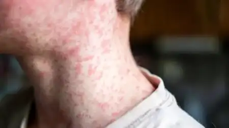 Se confirma el primer caso de sarampión del año en Argentina imagen-4