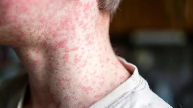 Se confirma el primer caso de sarampión del año en Argentina imagen-6