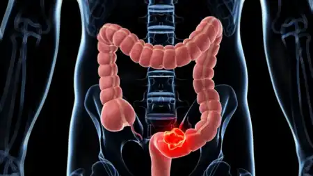 Misiones fortalece las acciones de prevención del cáncer de colon y destaca la disponibilidad de estudios gratuitos para la detección temprana imagen-5