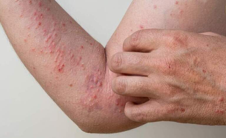 Chikungunya en el norte argentino: sin vacuna y con casos asintomáticos, alertan que la prevención en los hogares es clave para frenar el riesgo regional imagen-35