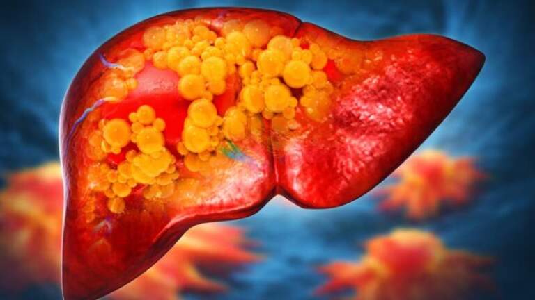 El hígado graso avanza sin control y enciende alarmas globales: estiman un aumento del 42% y hasta 2 mil millones de afectados en las próximas décadas imagen-15