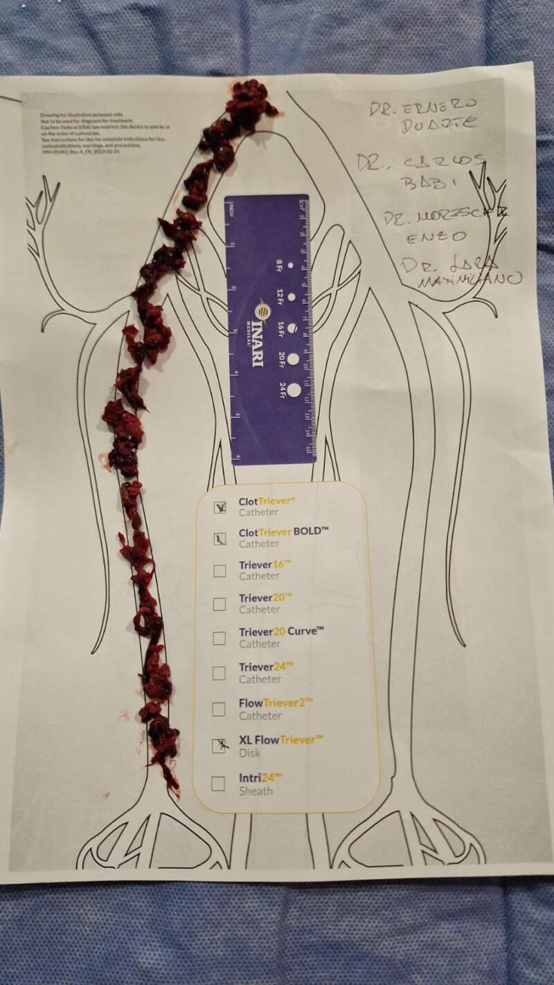 Hito sin precedentes: el Madariaga realizó la primera tromboaspiración pulmonar del NEA y cambió un pronóstico crítico imagen-5
