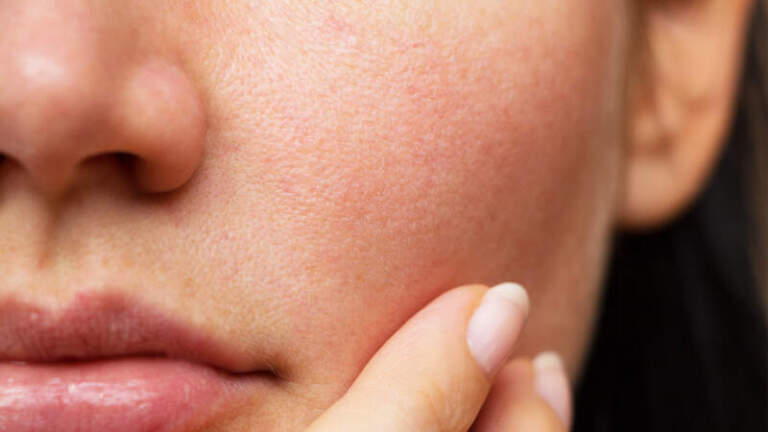 Piel en invierno: qué cuidados recomiendan para prevenir la deshidratación y proteger la barrera cutánea imagen-26