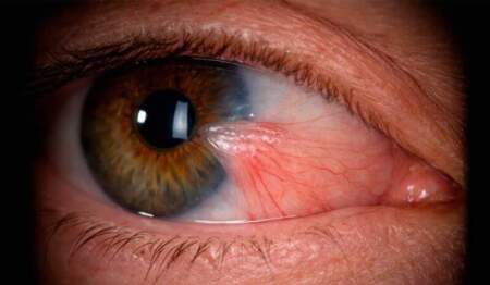 "Carnosidad en el ojo": por qué el pterigión es frecuente en Misiones, cómo puede afectar la visión y cuándo requiere cirugía imagen-11