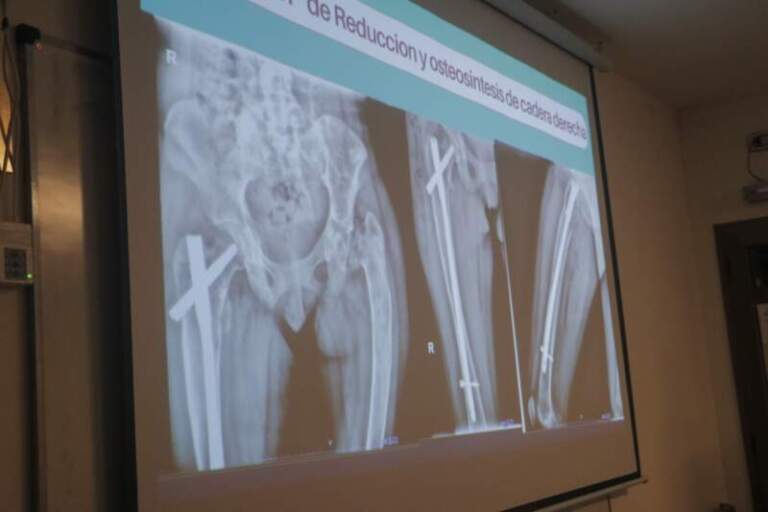 Un caso único en Misiones: el Hospital Madariaga trató una fractura de cadera vinculada a una rarísima enfermedad genética imagen-11